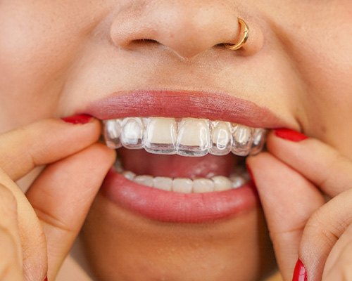 Woman putting in her Invisalign aligners