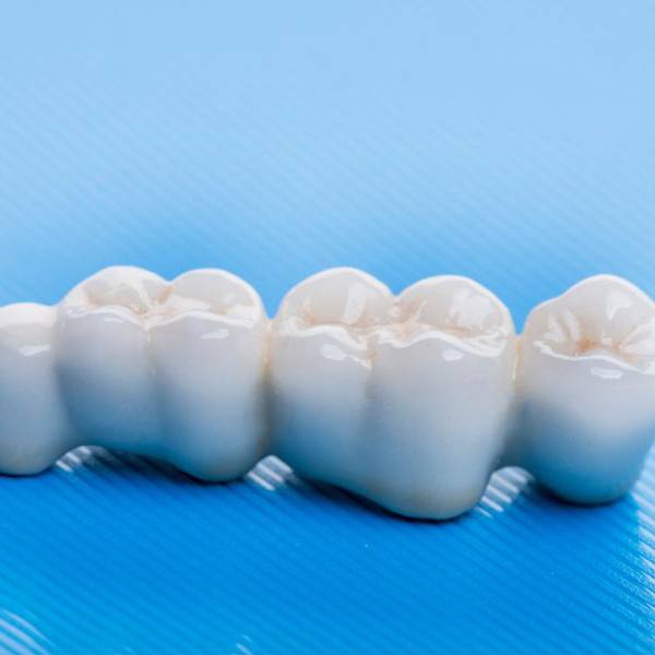 Illustration of dental bridge