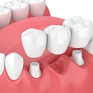 Exploded illustration of traditional dental bridge over treated teeth