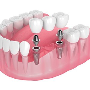 Exploded illustration of implant bridge in gum tissue