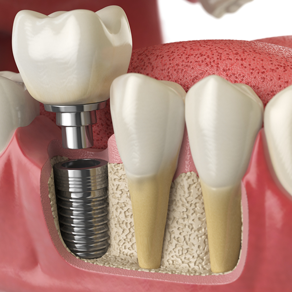Illustration of crown being attached to dental implant