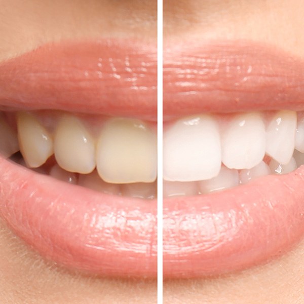 Patient's smile before and after teeth whitening