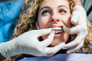 Female dental patient having Invisalign aligners placed on upper teeth